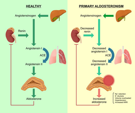 Aldosteronoma Healthy and primary aldosteronoma
