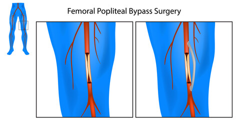 Femoral Popliteal Bypass Surgery. Leg Artery Bypass Surgery Diagram. Medical Chart of the Procedure for Leg Artery Blockage 