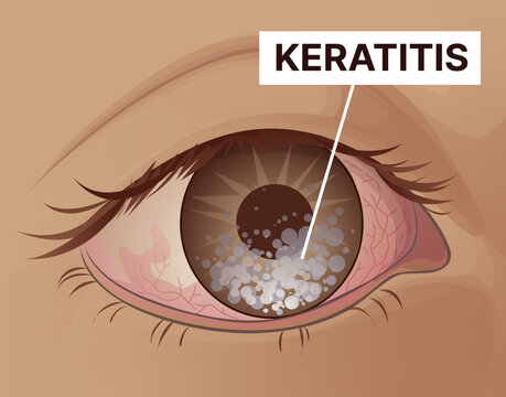Keratitis. Inflammation of the cornea. Healthcare illustration, educational illustration. Vector illustration.