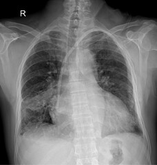 X-Ray Image Of Human Chest for a medical diagnosis