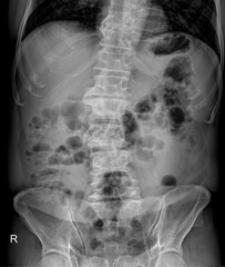 Abdomen Erect Radiograph for Diagnostic Imaging of Abdominal Conditions