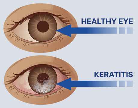 Keratitis. Inflammation of the cornea. Healthcare illustration, educational illustration. Vector illustration.