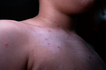 Fototapeta premium Closeup of Chickenpox Symptoms on Human Skin
