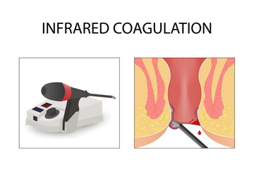 Infrared coagulation for hemorrhoids. Medical instruments, healthcare