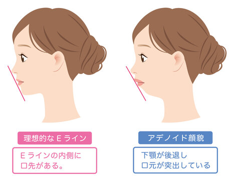 理想的なEラインと、アデノイド顔貌　交代した下顎　横顔