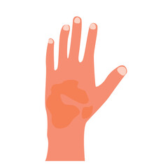 Skin diseases, contact dermatitis. Hand with scratches. Concept of healthcare and medicine. Skin irritation Flat vector illustration
