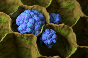 Lung cancer (LC) in the lung tissue – isometric view 3d illustration