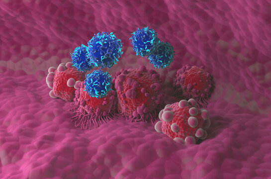 CAR T cell therapy in Pancreatic cancer - isometric view 3d illustration