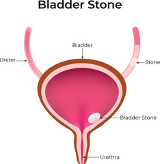 Bladder Stone, Ureter, Urethra, Vector Illustration