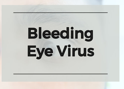 Bleeding Eye Virus term, Marburg virus. Deadly infected virus.