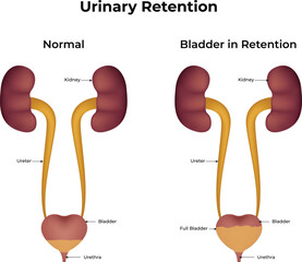 Urinary Retention Normal Bladder in Retention Design Vector Illustration