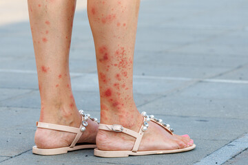 A women legs, which are in the phase of exacerbation of a skin disease. Skin diseases that worsen the quality of human life. Redness spots on the body. Dermatitis, allergy, eczema, psoriasis concept.
