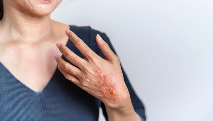 Discoid eczema is a chronic skin condition that causes skin