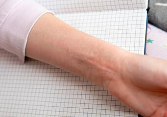 Young child having unexpected hives attack, also known as urticaria, is a kind of skin rash with red raised, itchy bumps.