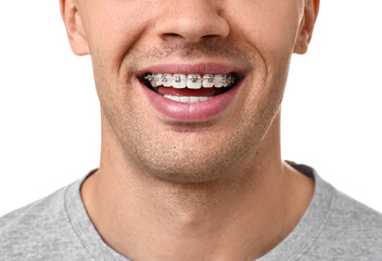 Obraz premium Smiling man with dental braces on white background, closeup