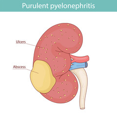 Kidney pyelonephritis, kidney abscess and ulcers. vector medical illustration