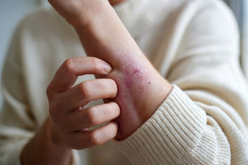 Close-Up of a Hand with Skin Rash and Irritation