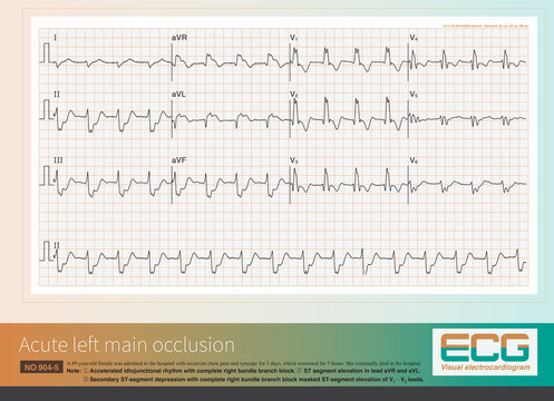 When acute left main artery occlusion causes ST segment elevation myocardial infarction, it is often accompanied by extensive anterior and high lateral myocardial infarction.
