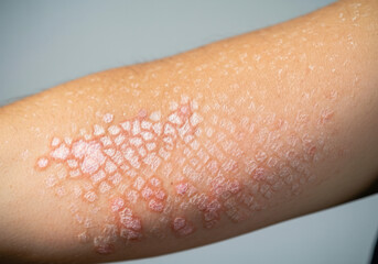 Skin condition with red patches and scaling seen during examination in a clinical setting