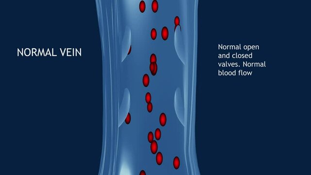 Varicose veins on a female senior legs. The structure of normal and varicose veins. Concept of dry skin, old senior people, varicose veins and deep vein thrombosis or DVT - 2D animation