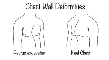 Chest Wall Deformities