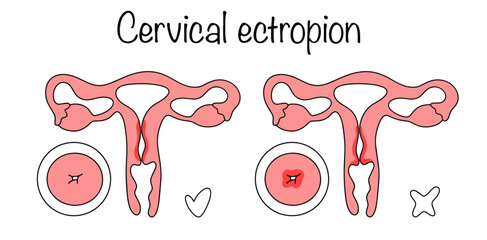 Cervical ectropion