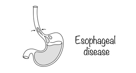 Obraz premium Esophageal disease