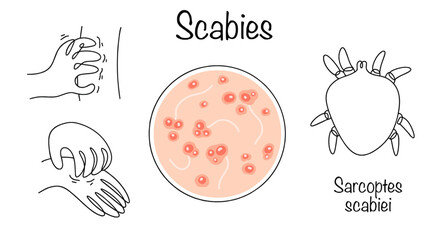 Scabies