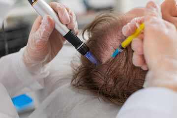 Alopecia. Man hair loss improve growth treatment regeneration, dermapen microneedling, vitamin...
