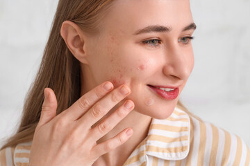 Young woman with acne problem and applied pimple patches on light background, closeup