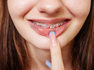 Naklejka premium A girl with braces on her teeth is smiling. The braces are pink and have a pink and white design with some decorative glamour elements. Health care concept. Very expensive procedure