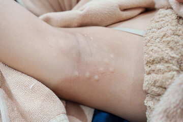 Medical specialist injecting syringe bacterial toxin botulin into armpit for reduce body odor and wrinkles