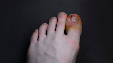 Part of the nail plate was removed after a severe and painful injury to the big toe of the left foot.