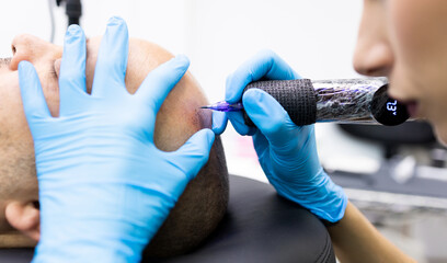 An unrecognizable professional woman performs a hair micropigmentation treatment on a man's scalp...