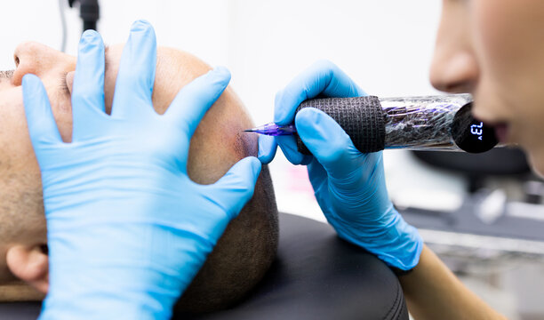 An unrecognizable professional woman performs a hair micropigmentation treatment on a man's scalp in a modern clinic.Concept of capillary micropigmentation.