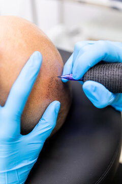 Vertical closeup photo of an unrecognizable female professional performing a hair micropigmentation treatment on a man's scalp in a modern clinic.Concept of capillary micropigmentation.