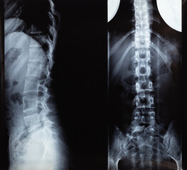 X-ray or MRI scan of Human spine with big intervertebral hernia. Diagnostic in clinic for treatment.