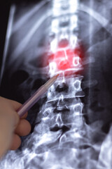 Doctor learn Vertical X-ray or MRI scan of Human spine with big intervertebral hernia. Diagnostic...