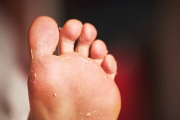 Fototapeta premium Feet with peeling skin after pedicure in a clinic