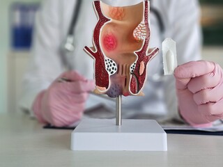 Proctologist doctor inserting rectal suppository into artificial model of human rectum concept