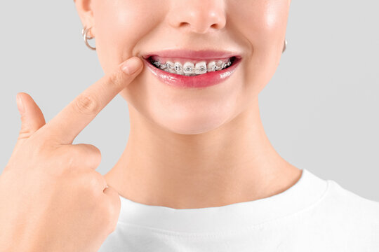 Young woman with dental braces smiling on light background, closeup