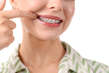 Young woman with dental braces smiling on white background, closeup