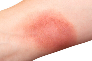 Burn on female hand skin close up macro isolated on white background.