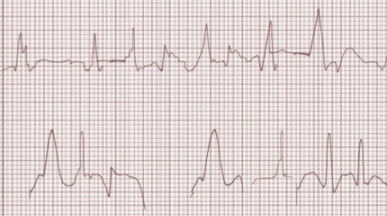 Naklejka premium Single Chamber Atrial Pacemaker ECG Rhythm: 8-Second Electrocardiogram Medical