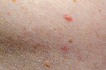 Nevus on human skin close-up