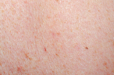 Nevus on human skin close-up