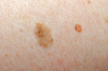 Nevus on human skin close-up