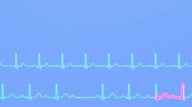 Comparison of ECG of normal heart rhythm and AV block 2nd degree