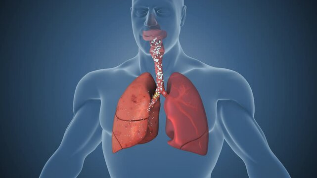 Air Exchange Compromised Due to Collapsed Lung Sections