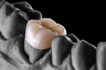 3d printed emax ceramic full crowns © Garo